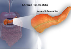 Surgery for Chronic Pancreatitis